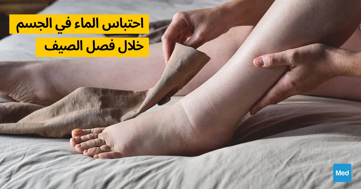 احتباس الماء في الجسم خلال فصل الصيف